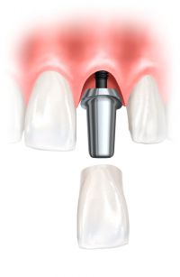 Einzelkrone auf Implantat